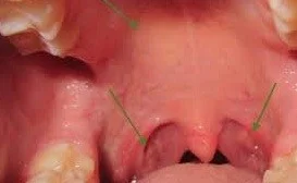 Itching of the nose, eyes, or the roof of the mouth